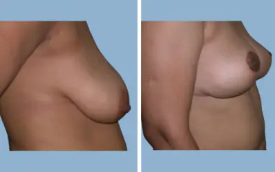 Before and After